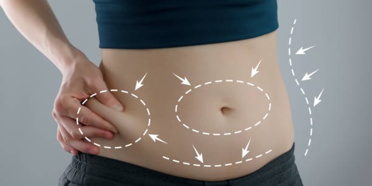 Can Liposuction Help Create a More Defined Waistline?