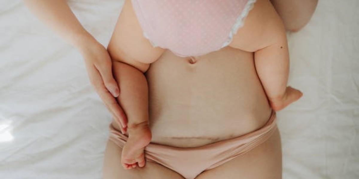 Tummy Tuck as Part of a Mommy Makeover: Understanding Its Role