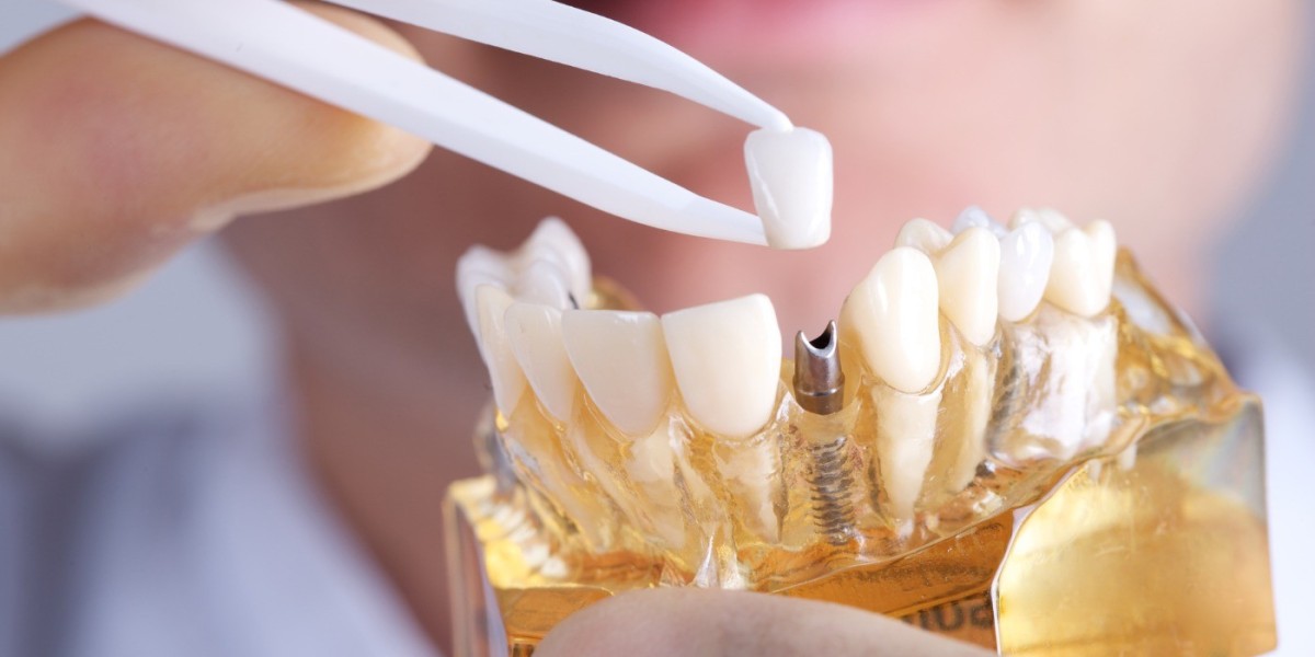 Cost of Dental Implants in Mumbai | Compare Treatment Prices