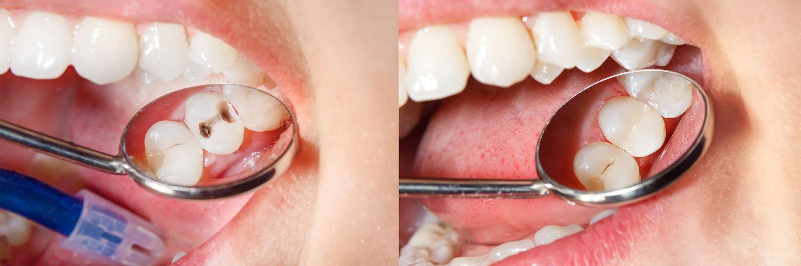 Composite Dental Filling Geelong, VIC | Composite Resin Fillings