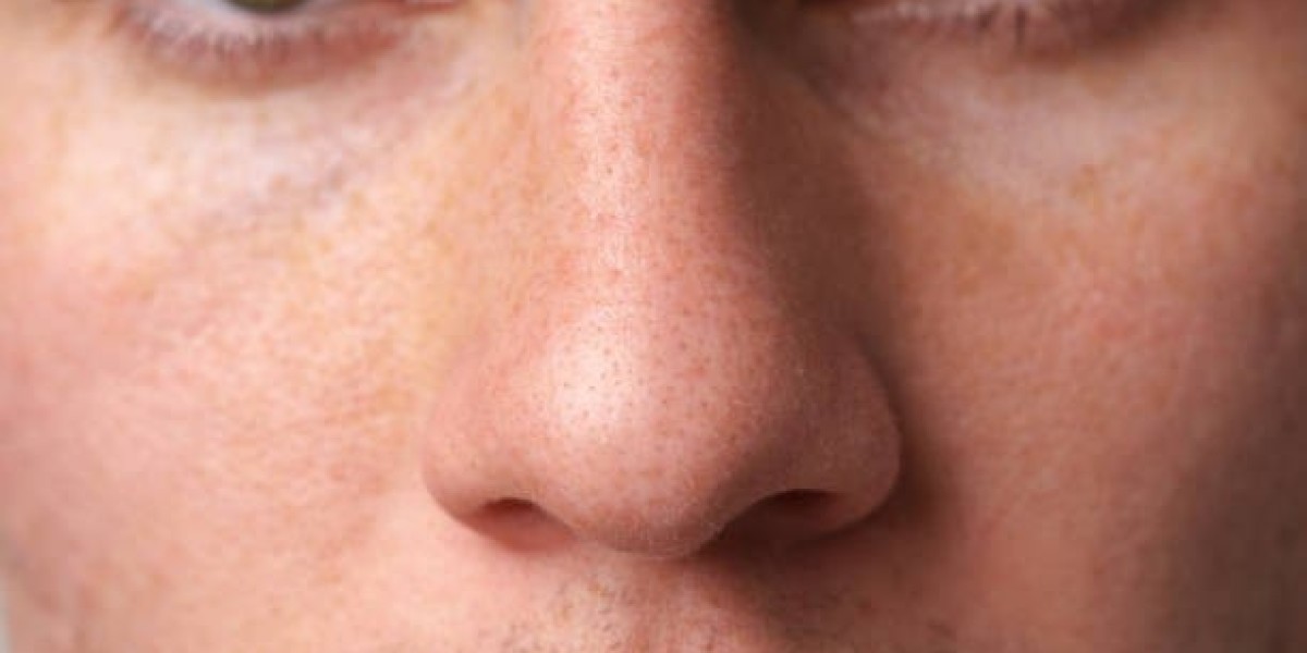 Natural Results from Riyadh’s Top Alarplasty Surgeons
