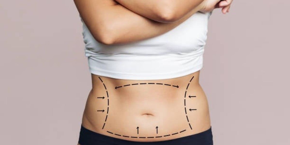 How to Choose a Liposuction Provider in Riyadh