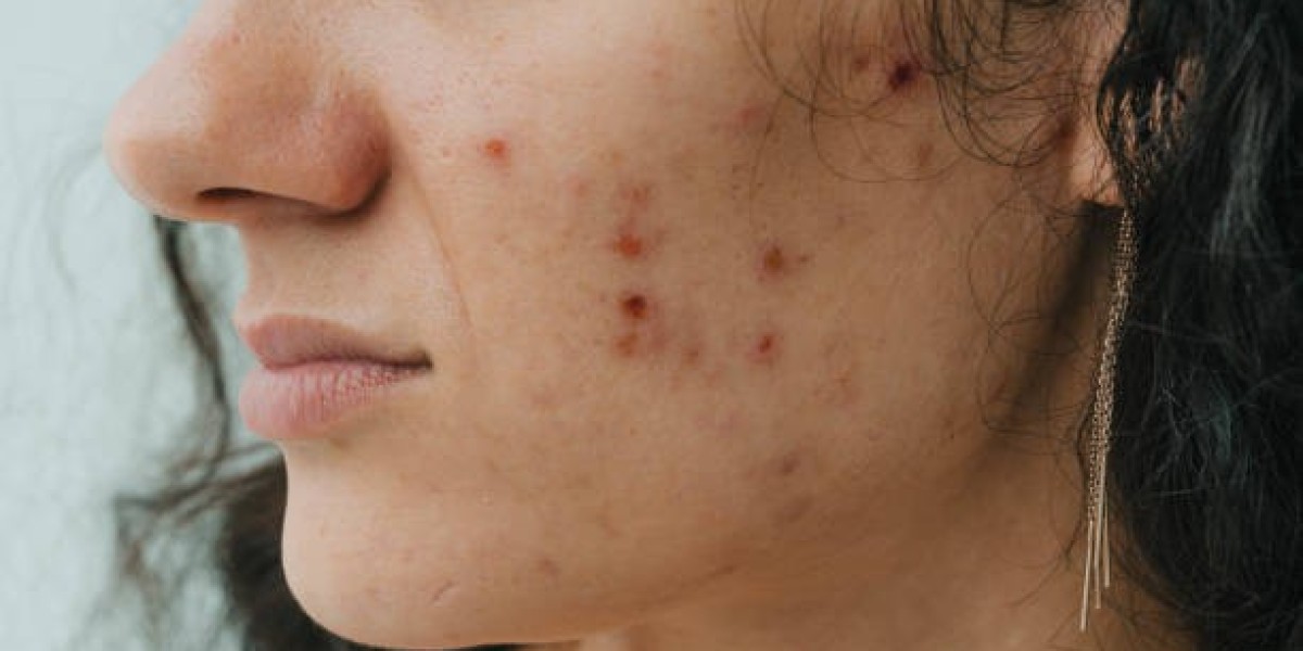 Combining Treatments for More Effective Acne Scar Management