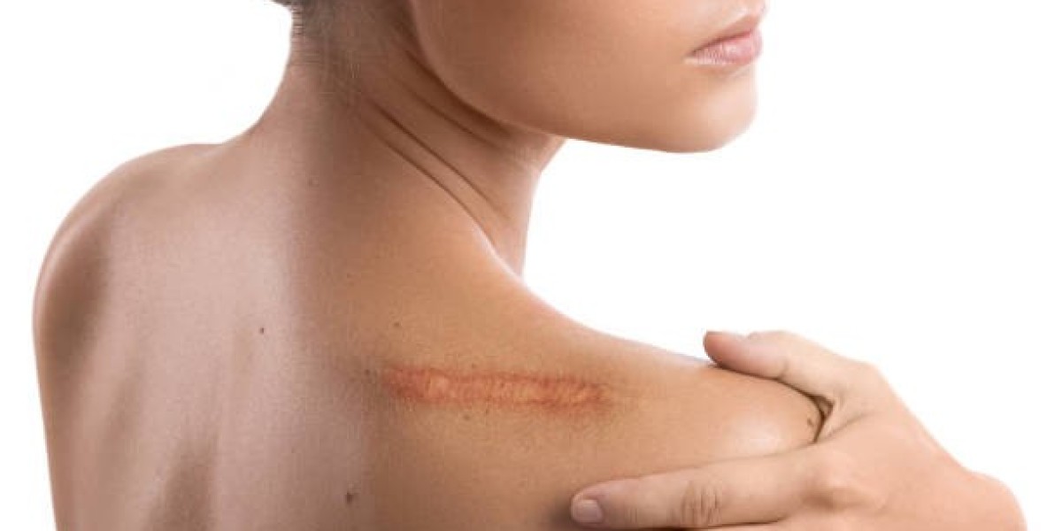 Keloid Treatment: Common Patient Concerns Explained