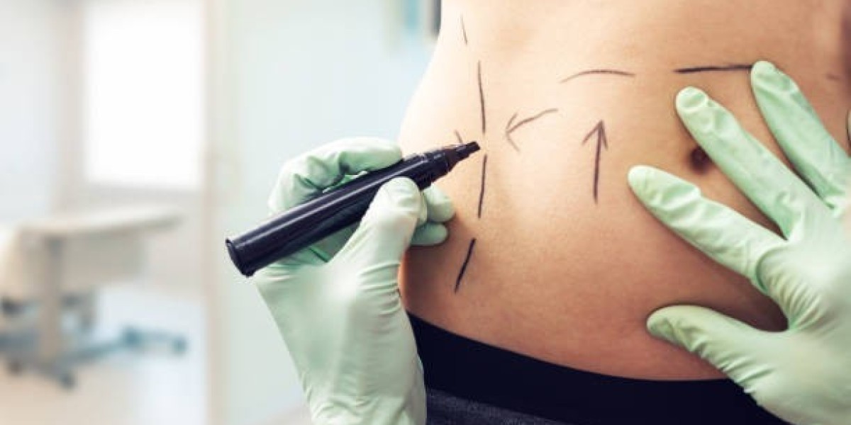Discovering Liposuction in Riyadh for Improved Body Shape and Confidence