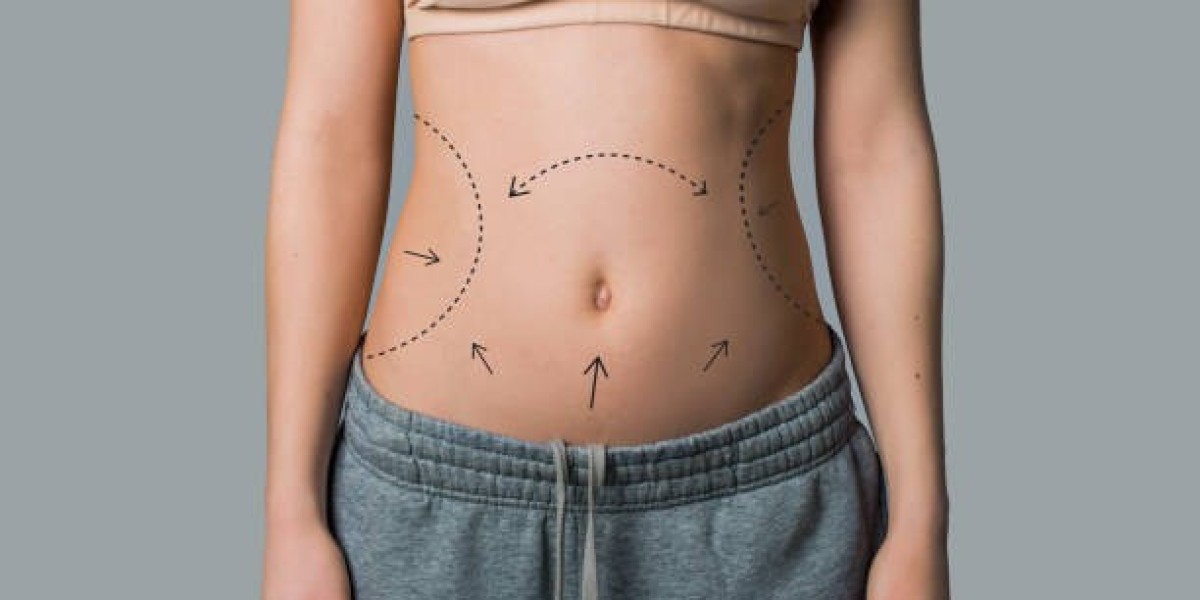 How Liposuction in Riyadh Can Enhance Body Proportions