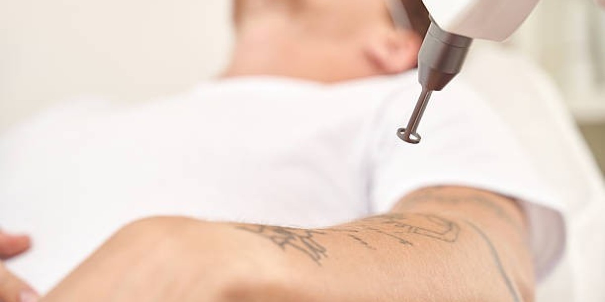 How Laser Tattoo Removal Technology Has Evolved