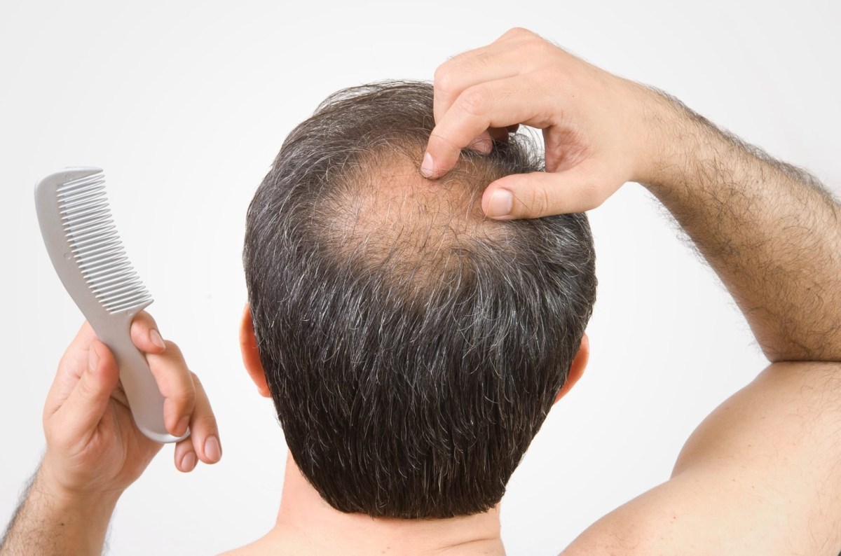 Hair Fall in Women and Men: Simple Guide to Treatment Options in Delhi – Best Hair Transplant Doctor In Delhi