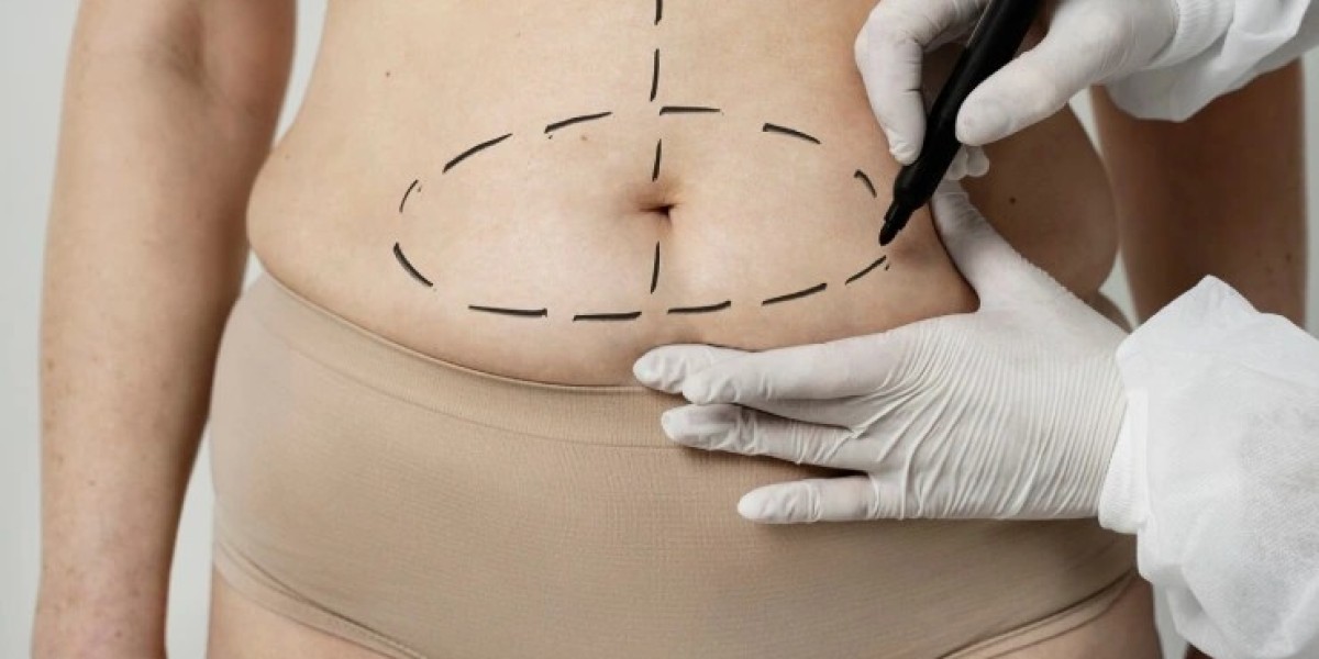Liposuction Surgery in Delhi: What Should You Look for When Choosing a Plastic Surgeon?
