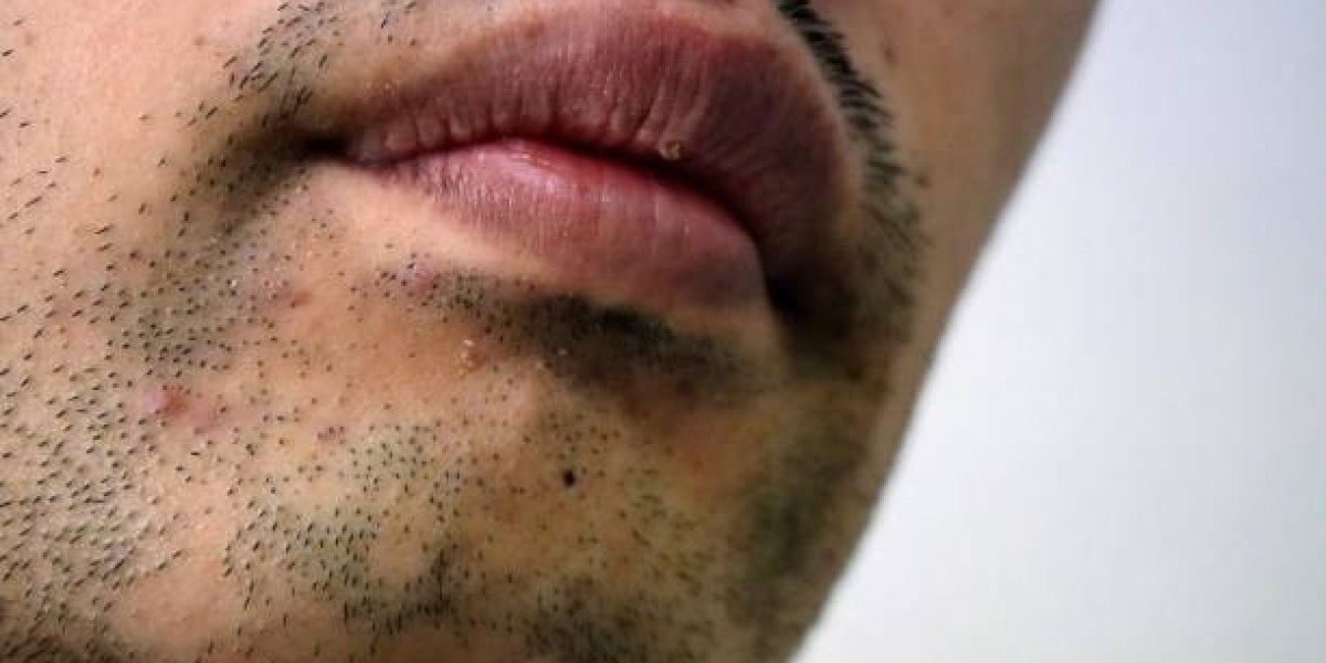 How Many Sessions Are Needed for Smoker’s Lips Treatment?