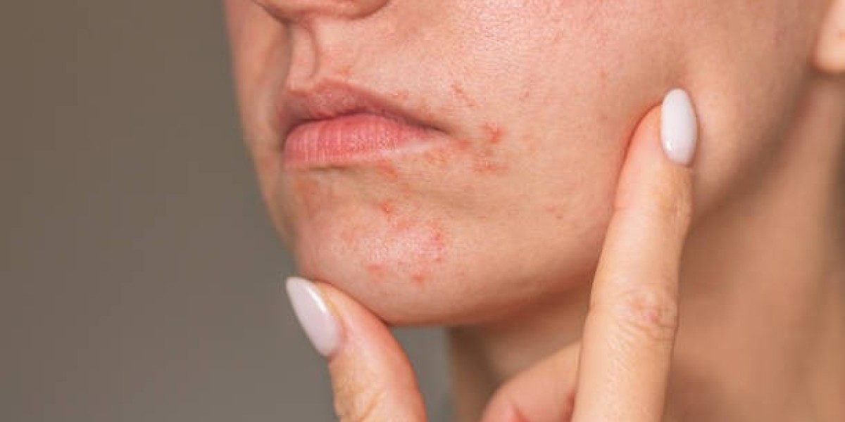 Tips for Supporting Better Acne Treatment Results