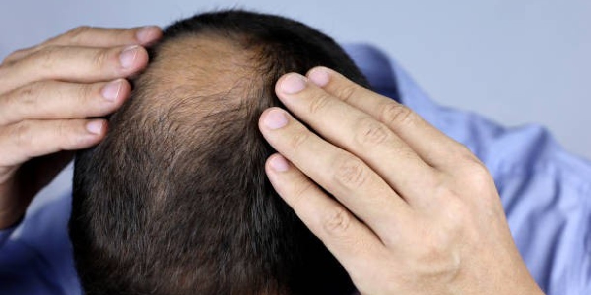 What Are the Possible Risks of PRP Hair Treatment?