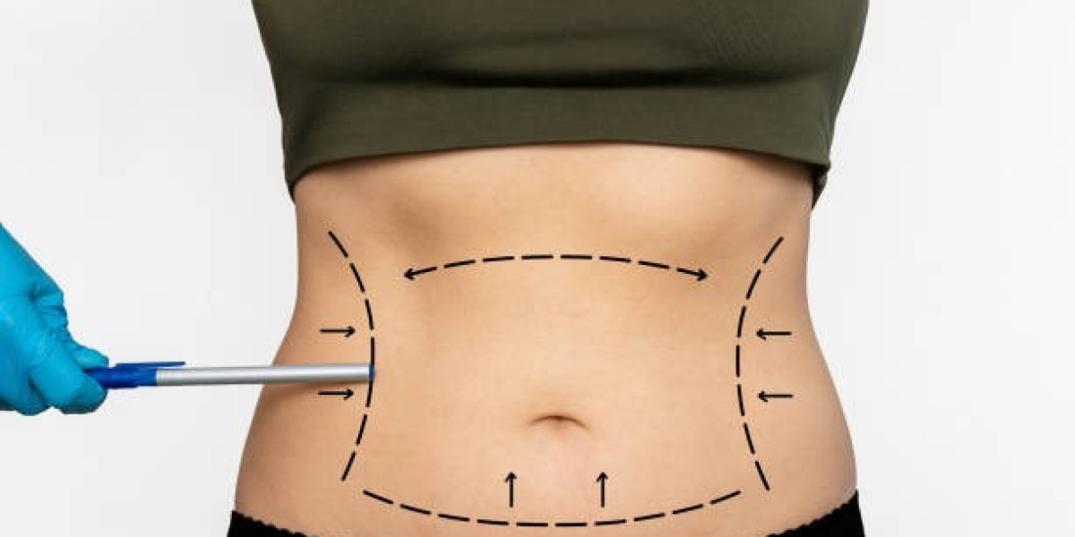 Liposuction for the Thighs: Procedure and Recovery