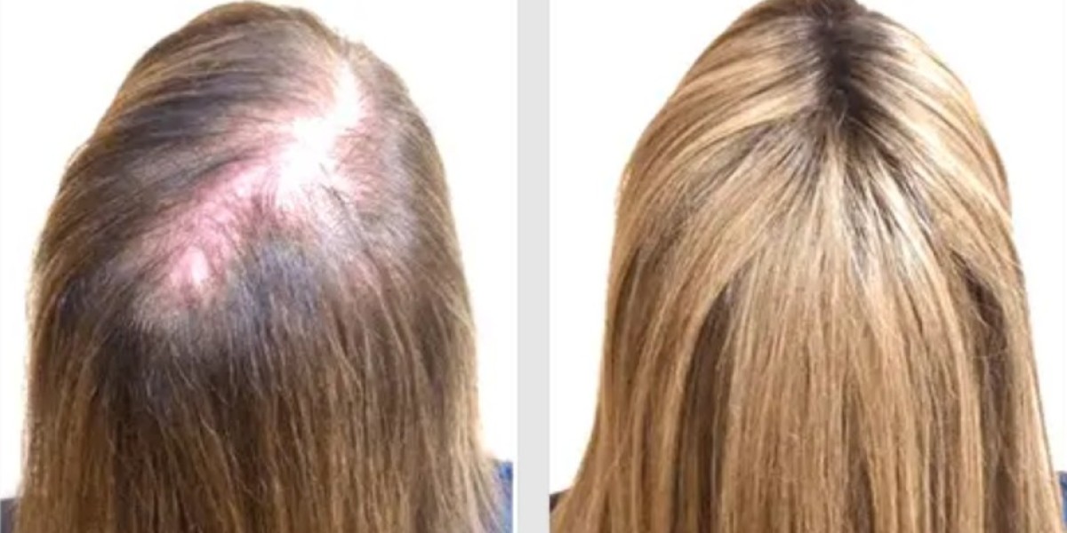 BioGrow Advanced Hair Regrowth US CA: Exploring Key