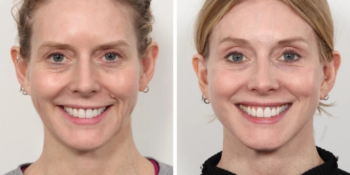 Best Doctors in Dubai for Thread Lift and Facial Firmness