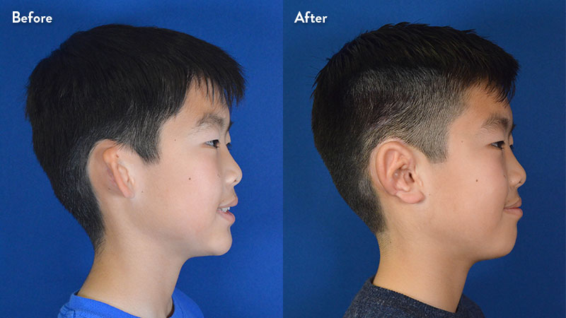 Ear Problems in Children and Adults: What Families in India Should Know – The Microtia Trust