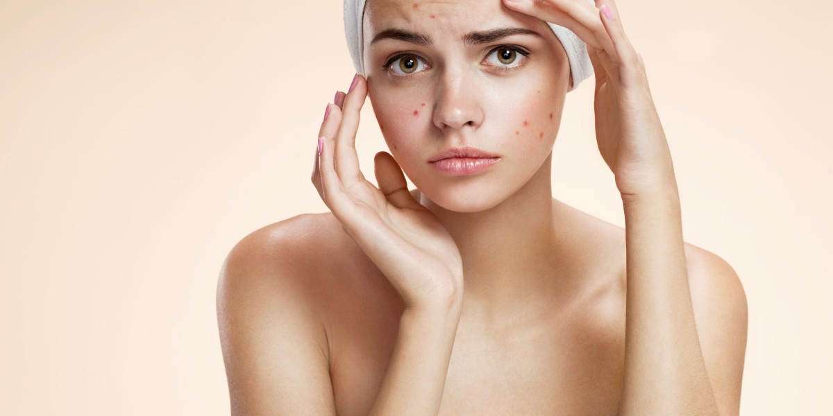 Laser Acne Scar Treatments in Riyadh for Smoother and Clearer Skin