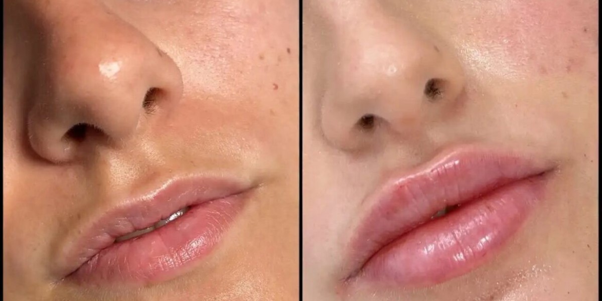 Best Aesthetic Clinics in Dubai for Fillers and Precision Cheek Enhancement