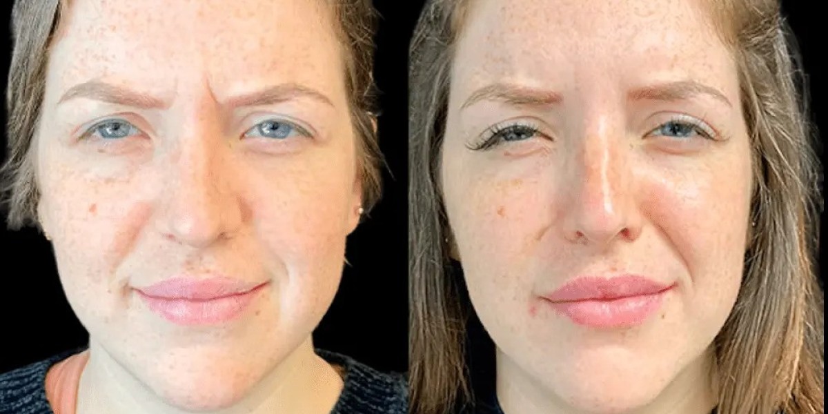 Botox in Dubai: What to Expect Before and After Treatment