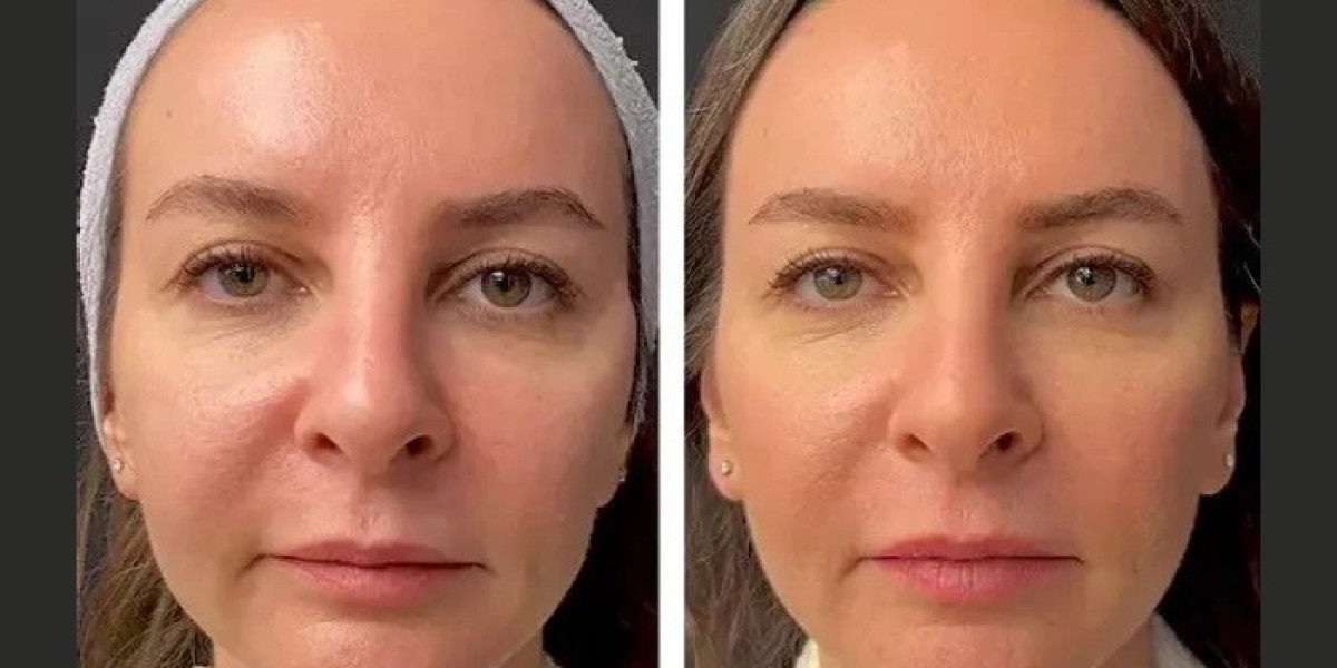 Mesotherapy in Dubai: Benefits, Uses, and Skin Rejuvenation Results