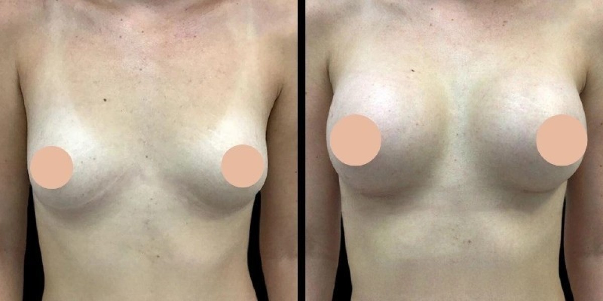 Best Doctors in Dubai for Choosing the Right Breast Implant Size