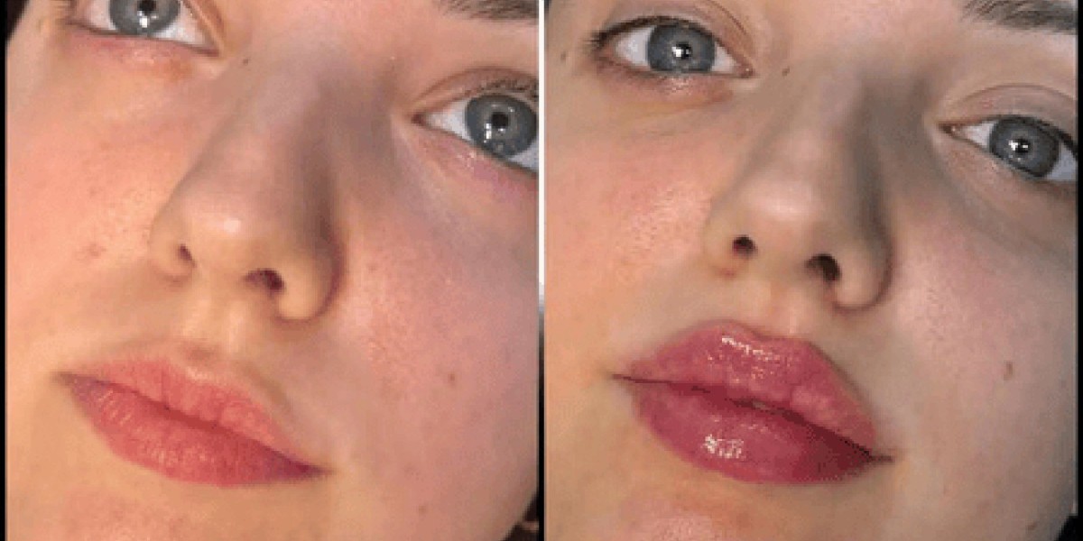 Fillers in Dubai for Advanced Volume Correction