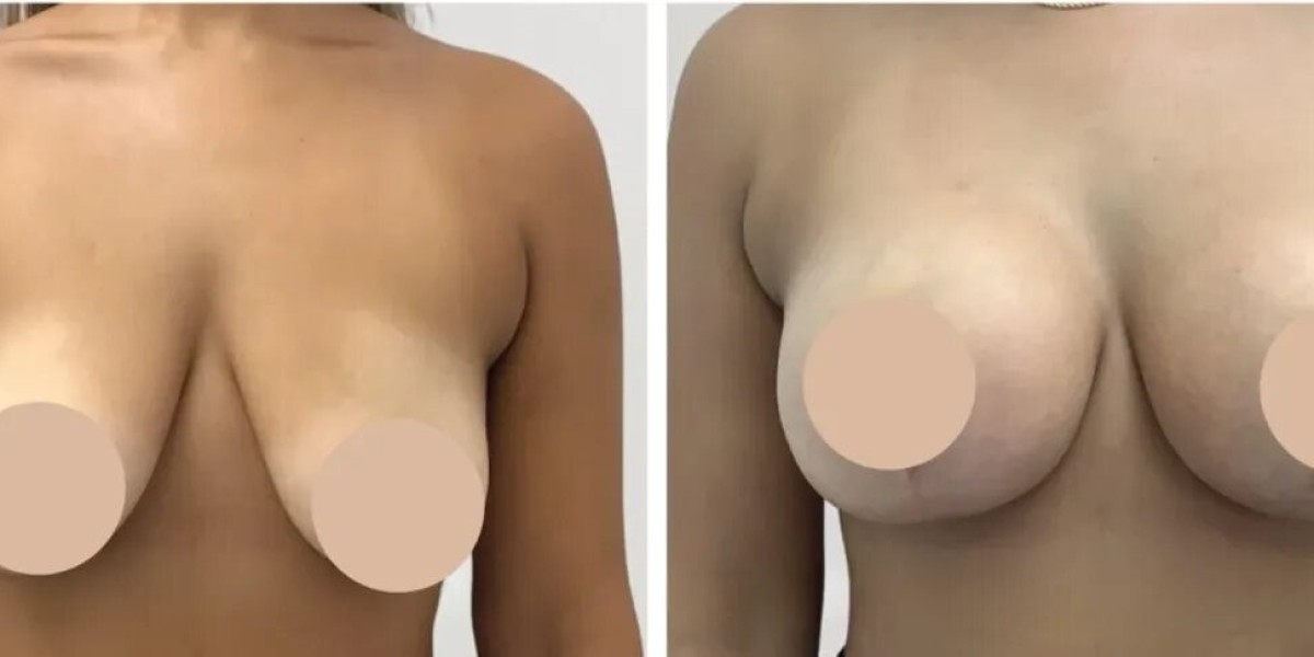 Best Breast Reduction Surgeons in Dubai for Personalized Breast Contouring