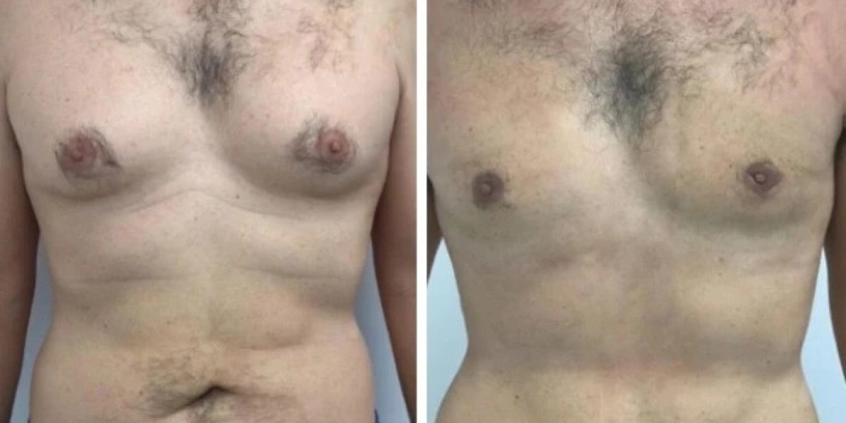 Best Gynecomastia Surgeons in Dubai for Enhanced Chest Proportions