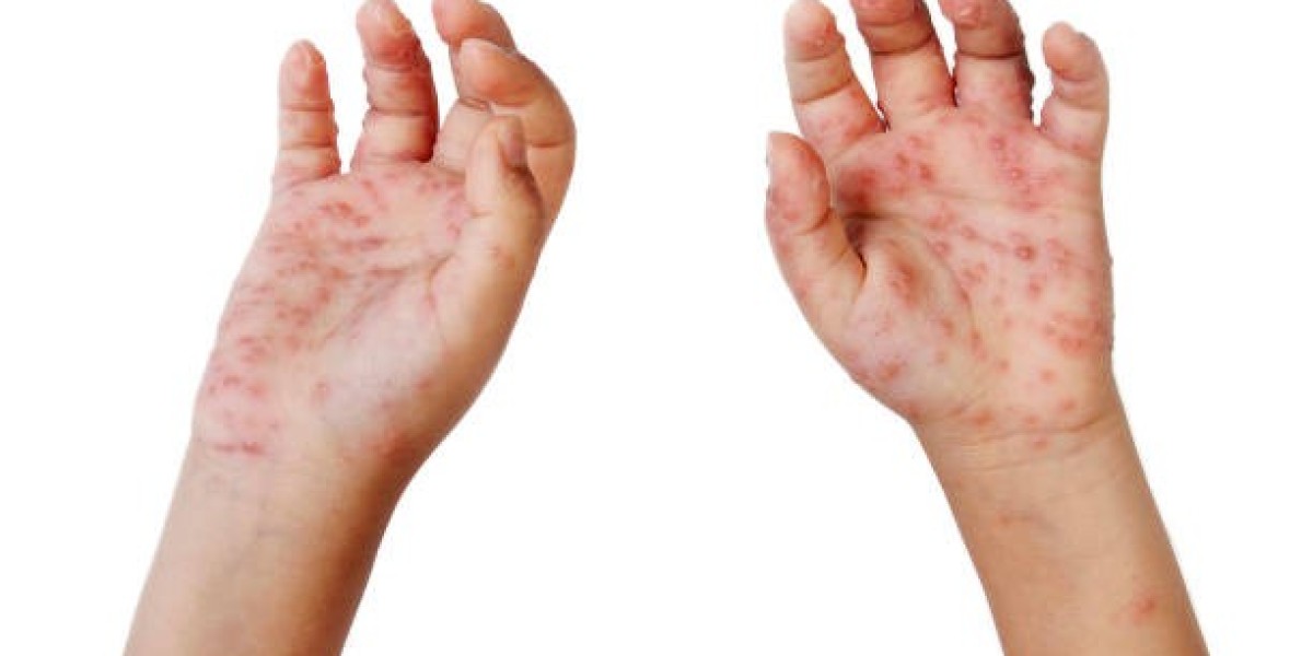 How to Treat Eczema on the Face Safely