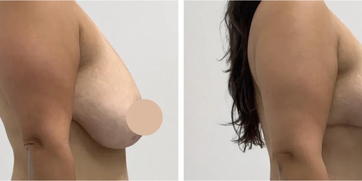 Best Breast Lift Surgeons in Dubai for Personalized Breast Rejuvenation