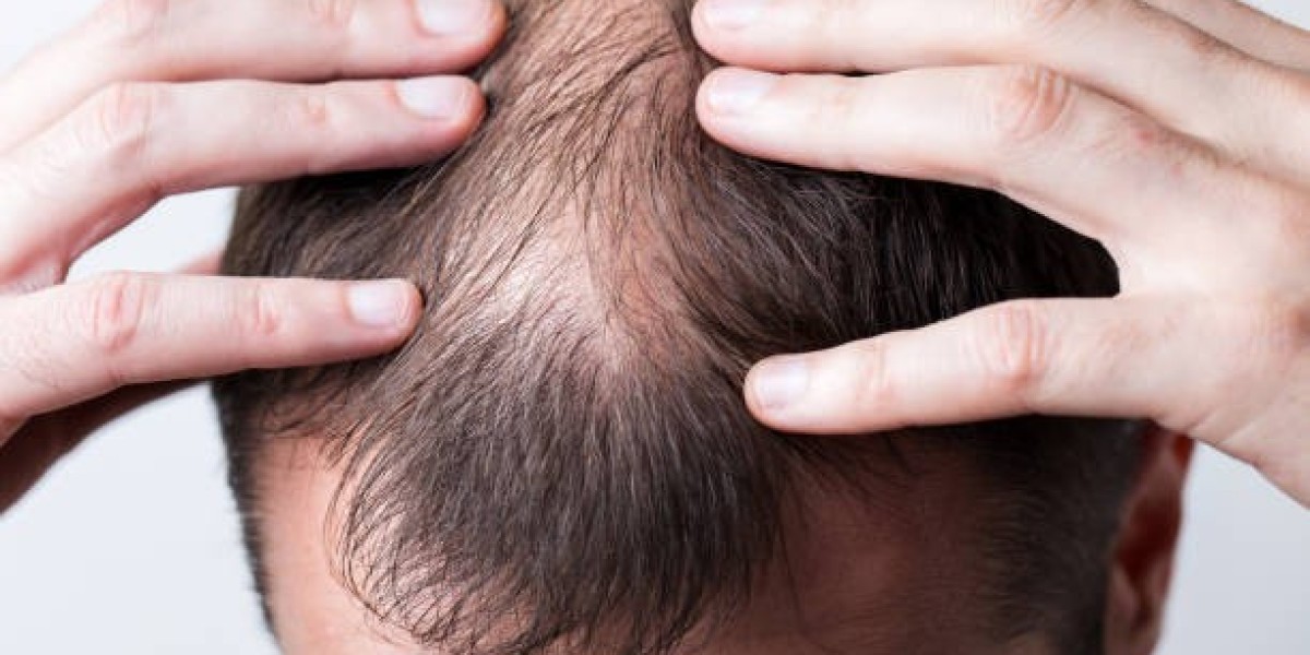 PRP Hair Treatment for Early Hair Thinning: What to Know