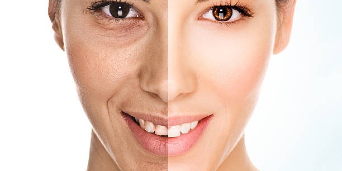 Facelift Surgery in Riyadh: How Surgeons Personalize Facial Treatment