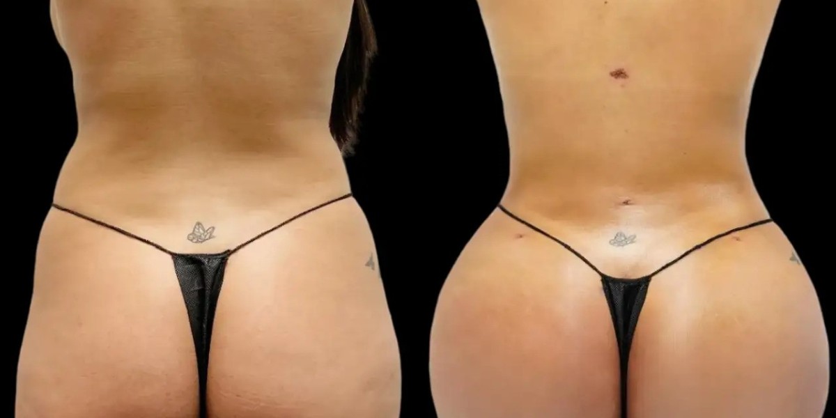 Fat transfer in Dubai: Understanding the Total Treatment Cost