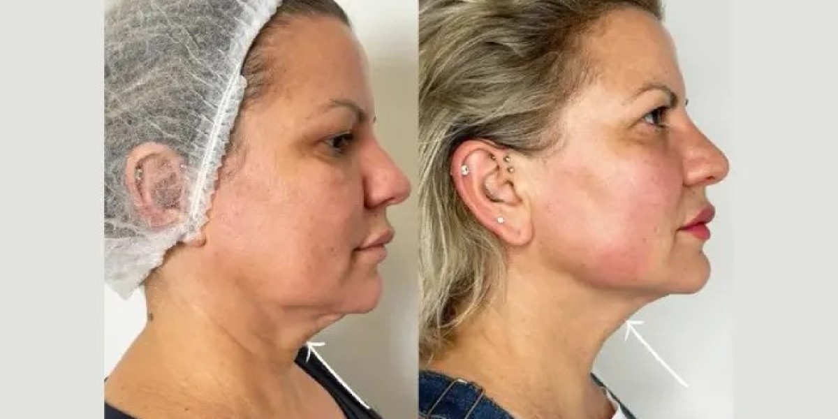 Endolift in dubai for Under Eye Contouring and Facial Rejuvenation